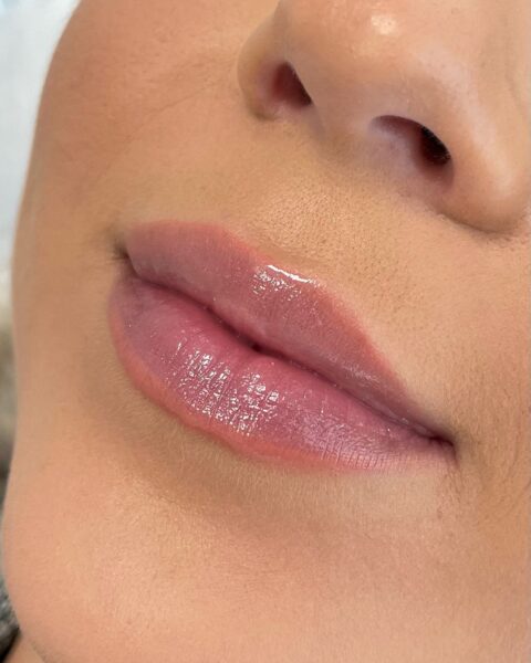 What to Do If You Have an Allergic Reaction to Lip Fillers