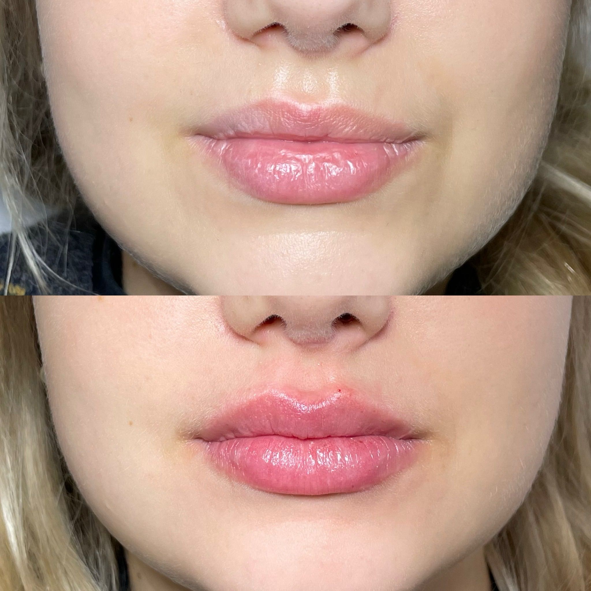 Lip Filler London - Natural Lip Enhancement & Lip Augmentation