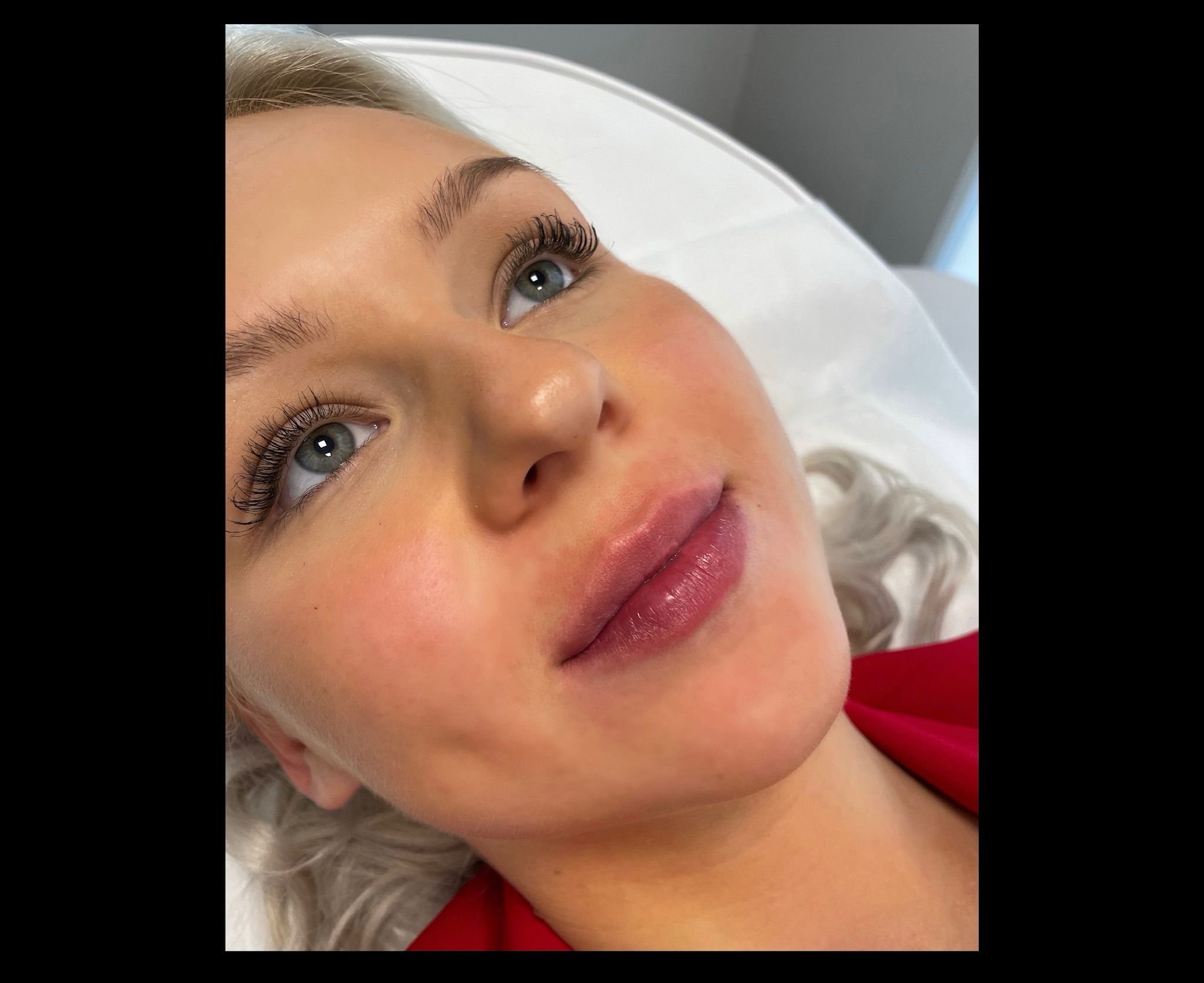 Lip Filler London - Natural Lip Enhancement & Lip Augmentation