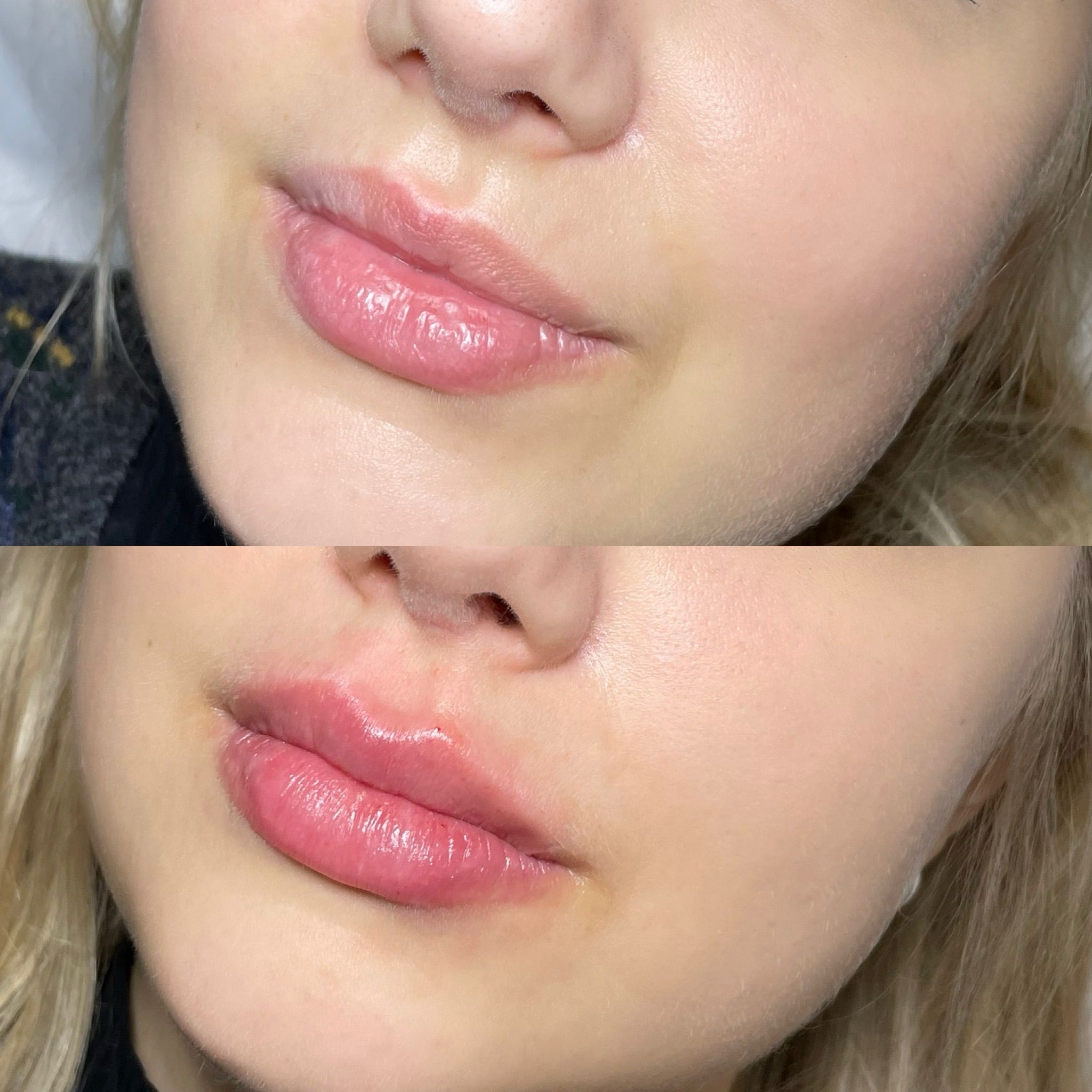 Lip Filler London - Natural Lip Enhancement & Lip Augmentation