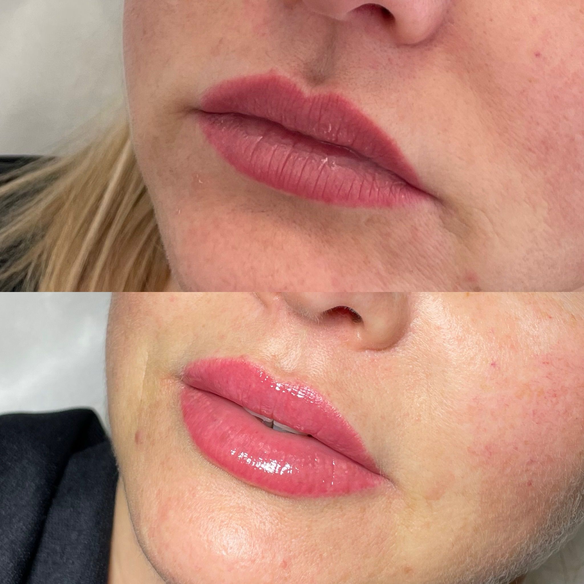 Lip Filler London - Natural Lip Enhancement & Lip Augmentation