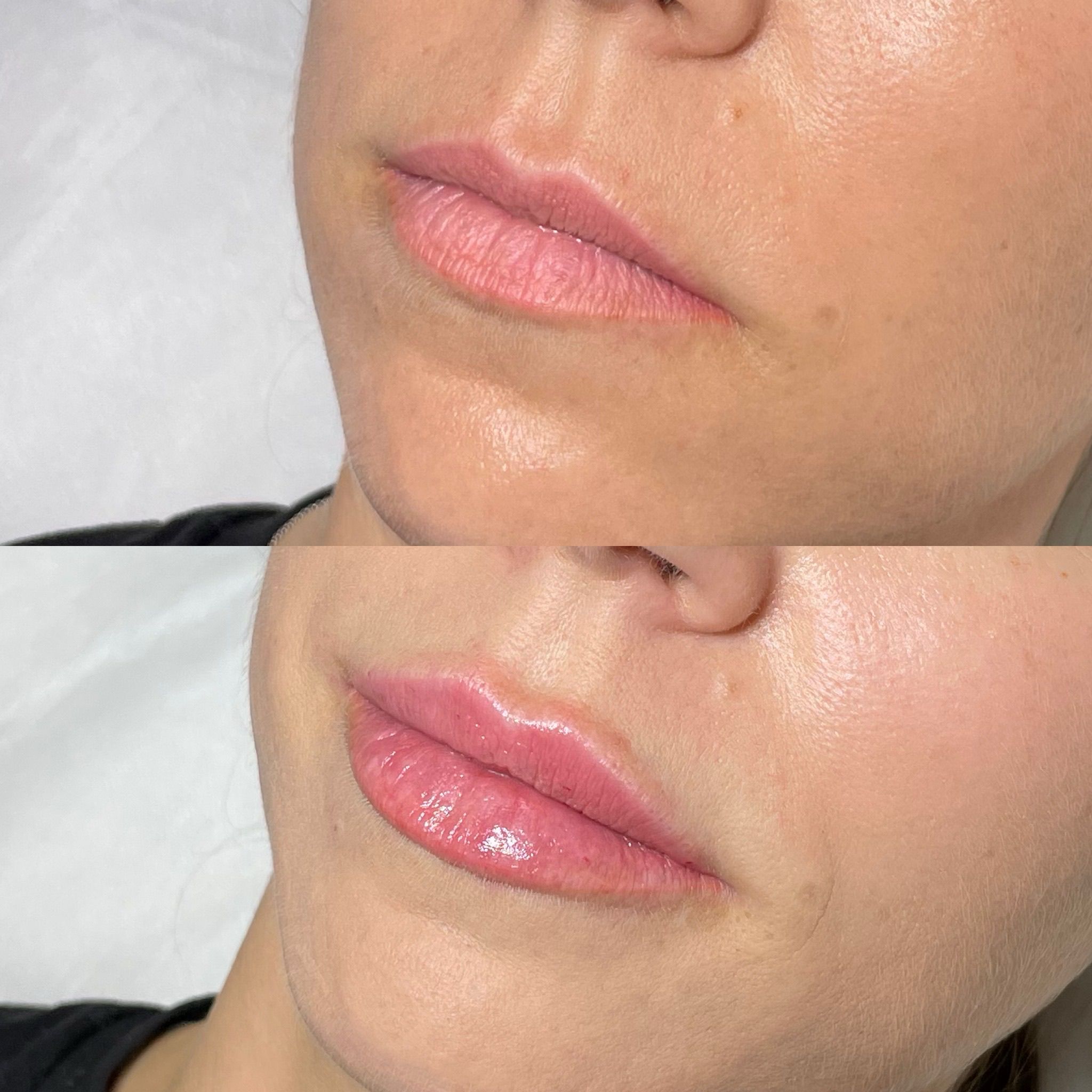 Lip Filler London - Natural Lip Enhancement & Lip Augmentation