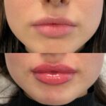 Lip filler before and after (7)