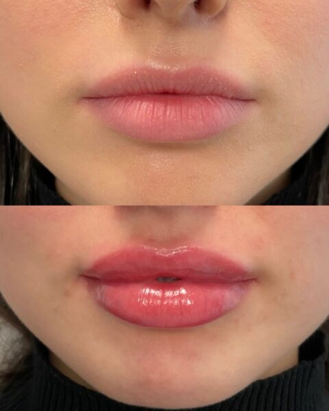 Lip filler before and after (7)
