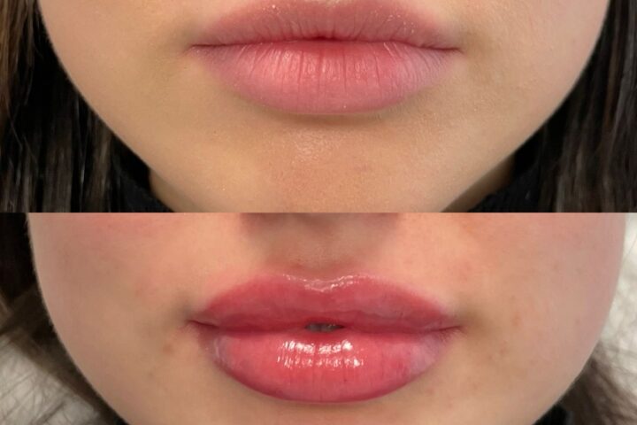 Lip filler before and after (7)